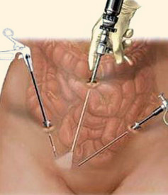 Laparoscopic Hysterectomy